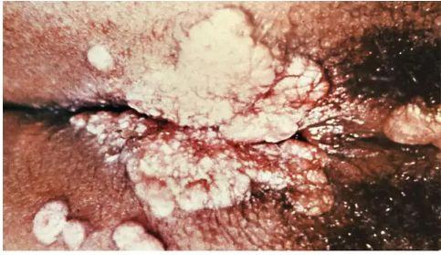 尖锐性湿疣可以吃茭瓜,战胜尖锐性湿疣——天然食疗新选择”